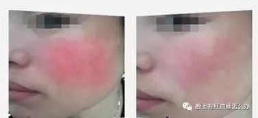 (发际线干皮怎么回事)发际线干皮像癣一样？如何有效改善这一问题