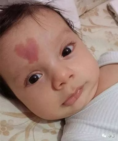 (天使之吻胎记微信群)天使之吻胎记会自然消失吗?如何有效去除这种瑕疵? (天使之吻胎记微信群)天使之吻胎记会自然消失吗?如何有效去除这种瑕疵?