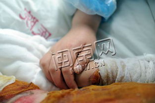 (被岩浆烫伤会怎么样)被岩浆烫伤：面对灼热岩浆，切勿掉以轻心，瞬间伤痕永存